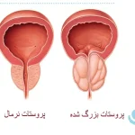 درمان بیماری‌های پروستات