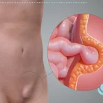 همه‌چیز درباره جراحی هرنی