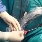 مزایا و معایب جراحی لیزری سنگ کلیه