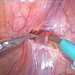 عمل جراحی واریکوسل؛ هر آنچه باید بدانید