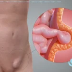 فتق چیست و چه علائمی دارد؟