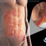 آیا هر فتقی نیاز به جراحی دارد؟