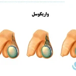 تفاوت واریکوسل درجه ۱، ۲ و ۳ چیست؟