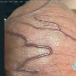 آیا واریکوسل بدون جراحی درمان می‌شود؟