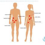 تفاوت فتق اینگوینال و فمورال چیست؟