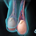 نقش واریکوسل در ناباروری مردان